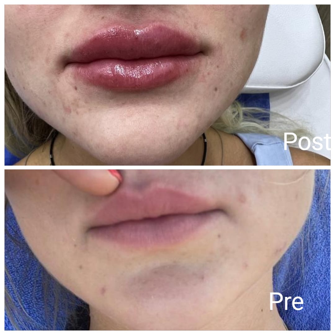 Lip augmentation